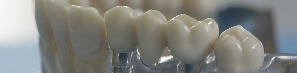 Implantatversorgung Implantatversorgung