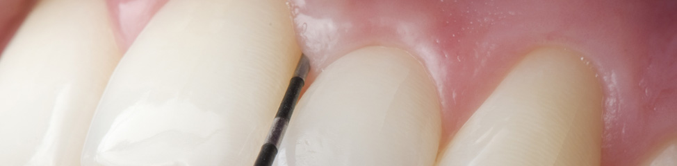 Parodontalbehandlung Parodontalbehandlung